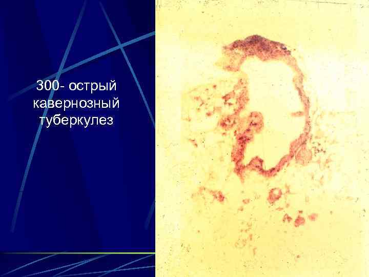 300 - острый кавернозный туберкулез 