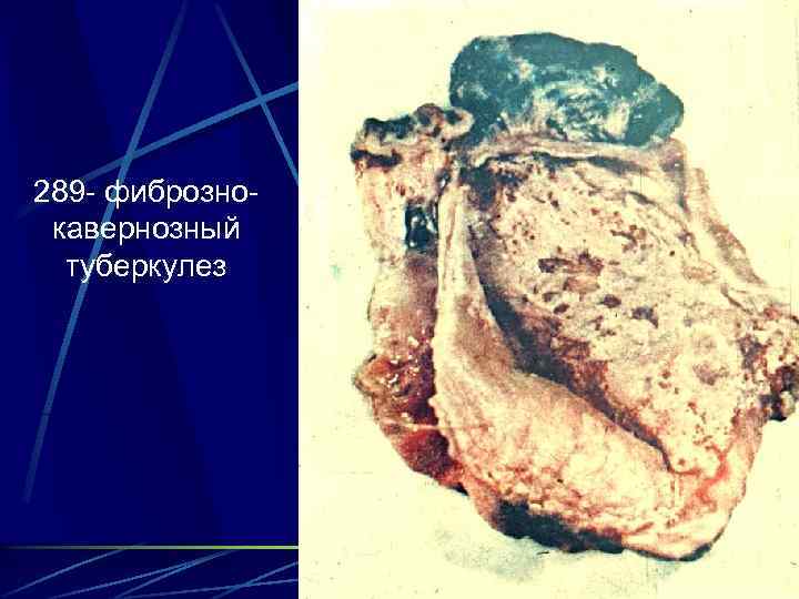 289 - фибрознокавернозный туберкулез 