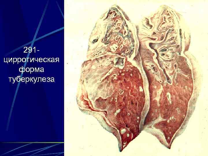 291 цирротическая форма туберкулеза 