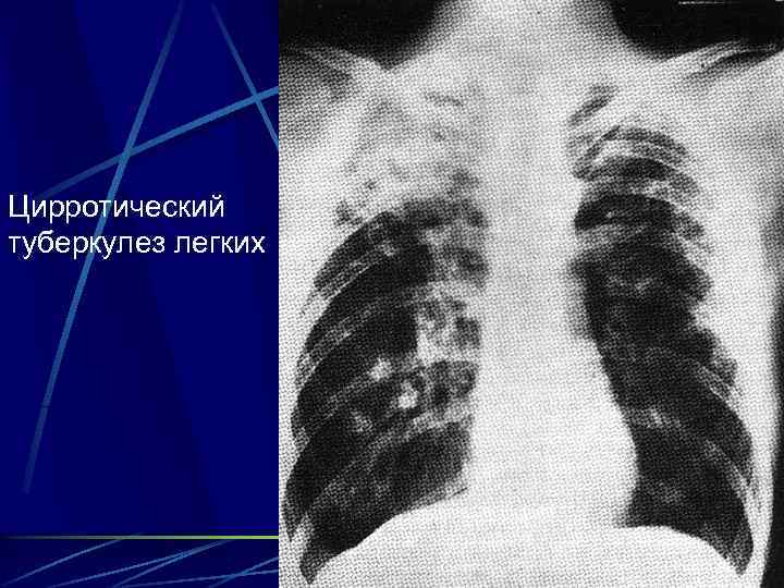 Цирротический туберкулез легких 