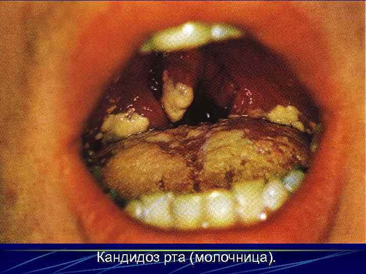 Кандидоз рта (молочница). 