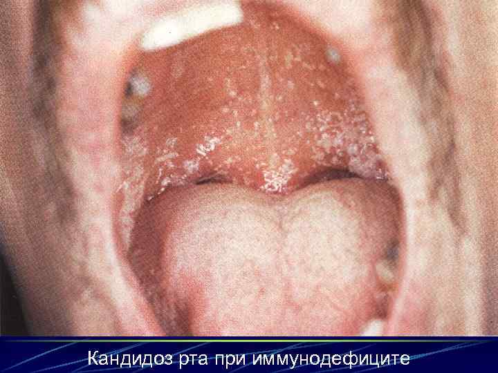 Кандидоз рта при иммунодефиците 