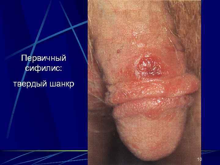 Первичный сифилис: твердый шанкр 10 