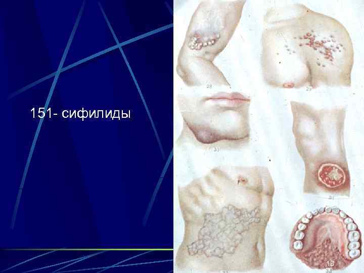 151 - сифилиды 18 