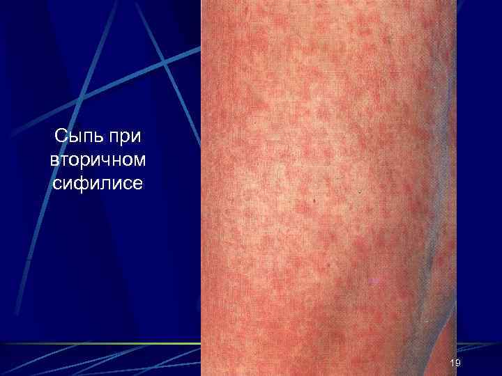 Сыпь при вторичном сифилисе 19 