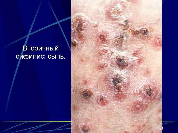 Вторичный сифилис: сыпь. 21 