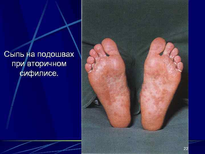Сыпь на подошвах при вторичном сифилисе. 22 