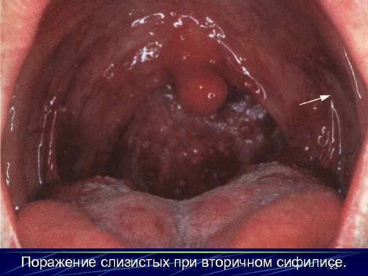 Поражение слизистых при вторичном сифилисе. 23 