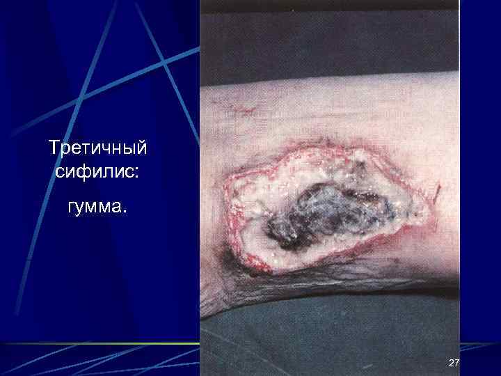Третичный сифилис: гумма. 27 