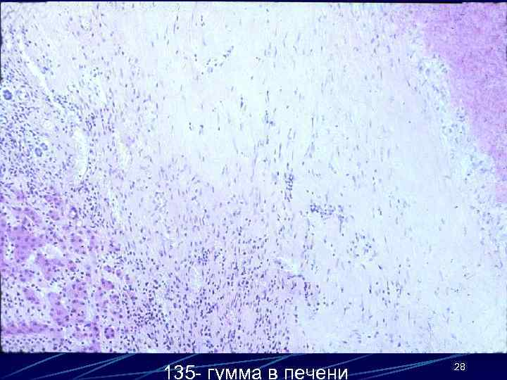 135 - гумма в печени 28 
