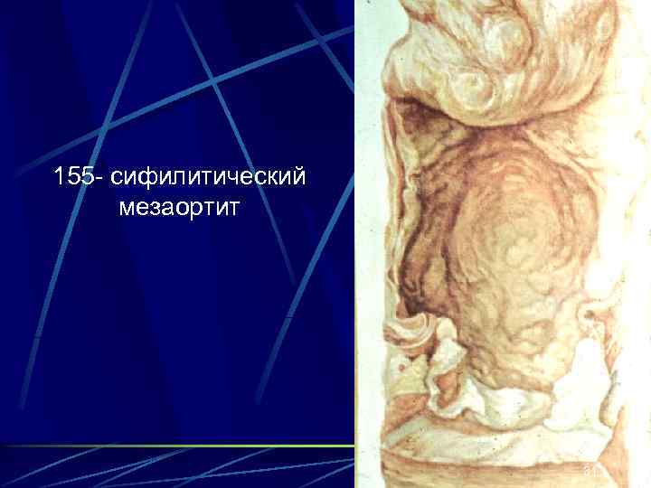 155 - сифилитический мезаортит 31 