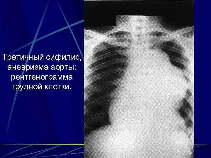 Третичный сифилис, аневризма аорты: рентгенограмма грудной клетки. 32 
