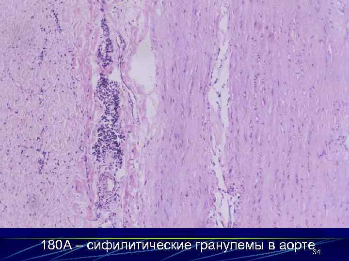 180 А – сифилитические гранулемы в аорте 34 