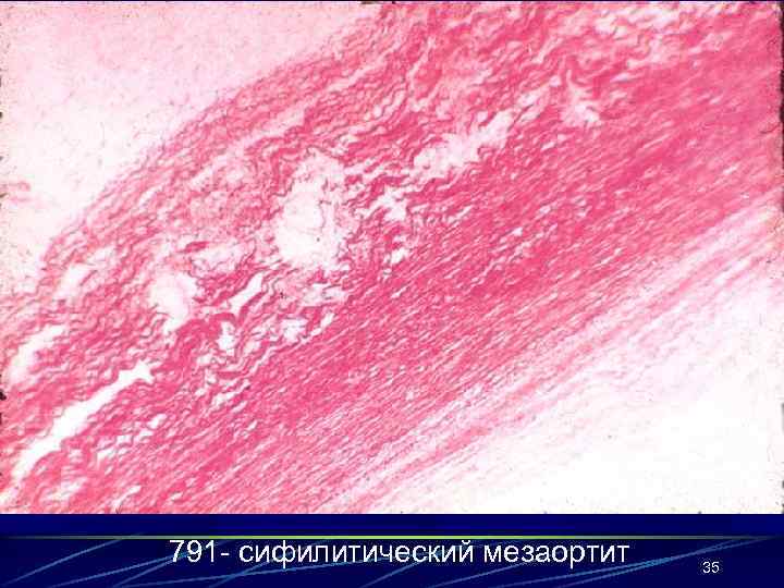 791 - сифилитический мезаортит 35 