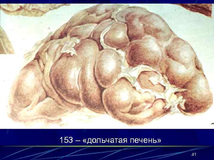 153 – «дольчатая печень» 41 