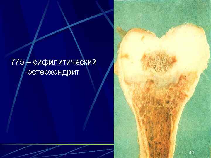 775 – сифилитический остеохондрит 43 