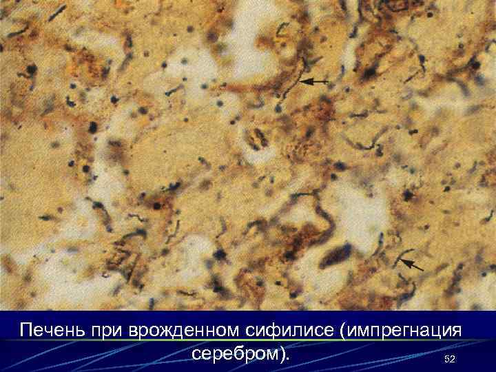 Печень при врожденном сифилисе (импрегнация серебром). 52 