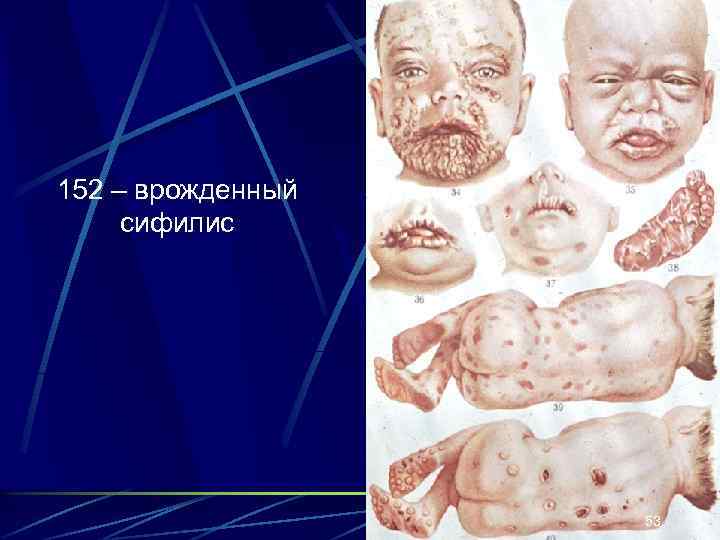 152 – врожденный сифилис 53 
