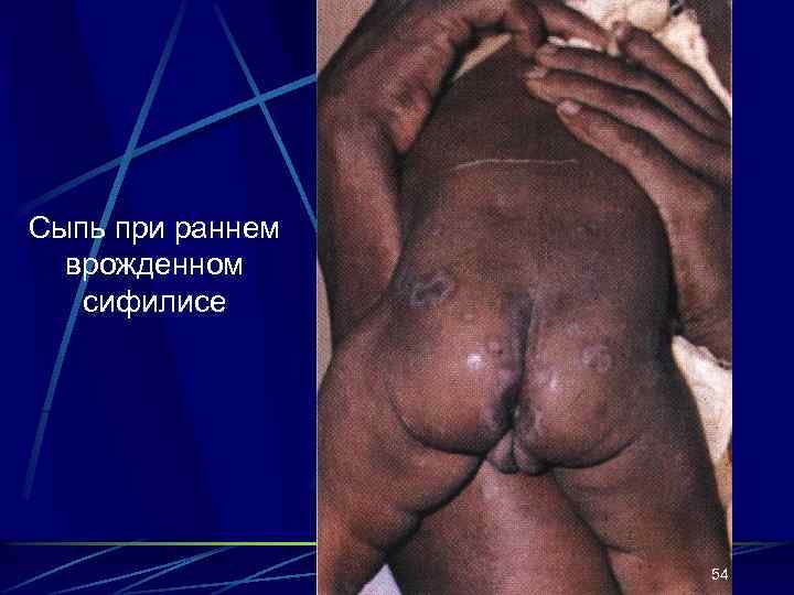 Сыпь при раннем врожденном сифилисе 54 