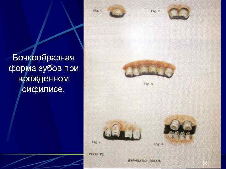 Бочкообразная форма зубов при врожденном сифилисе. 56 
