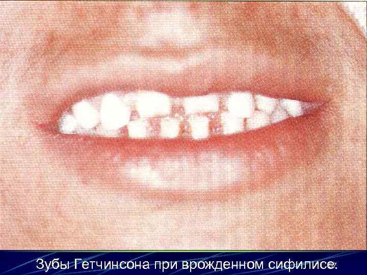 57 Зубы Гетчинсона при врожденном сифилисе. 