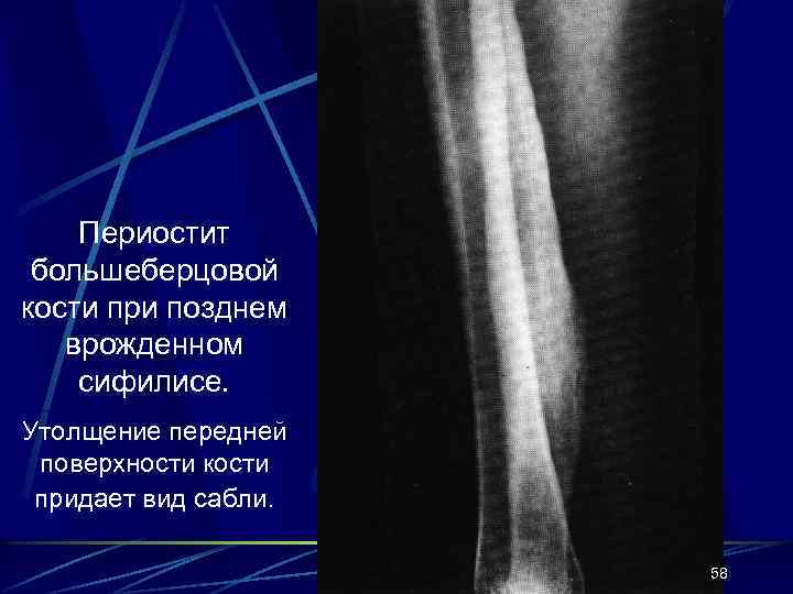 Периостит большеберцовой кости при позднем врожденном сифилисе. Утолщение передней поверхности кости придает вид сабли.