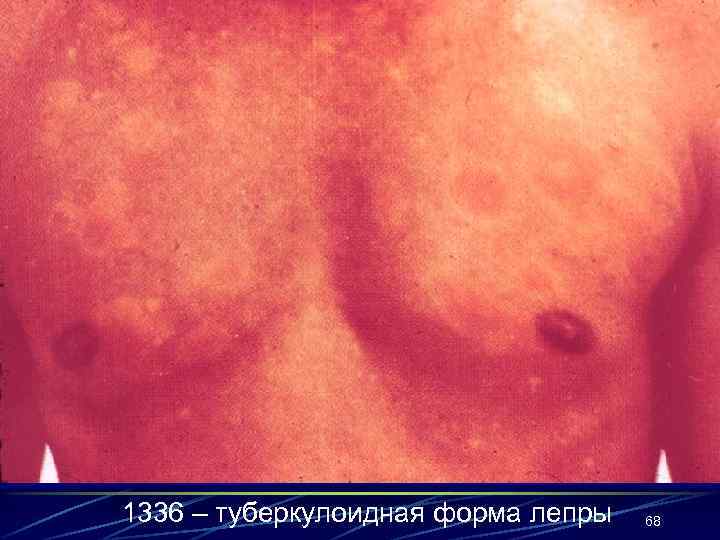 1336 – туберкулоидная форма лепры 68 