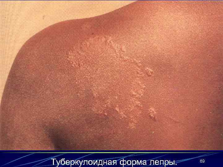 Туберкулоидная форма лепры. 69 