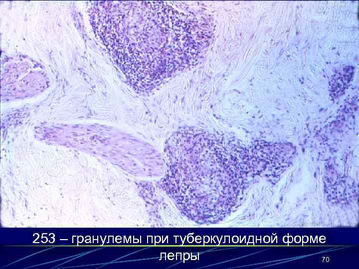 253 – гранулемы при туберкулоидной форме лепры 70 
