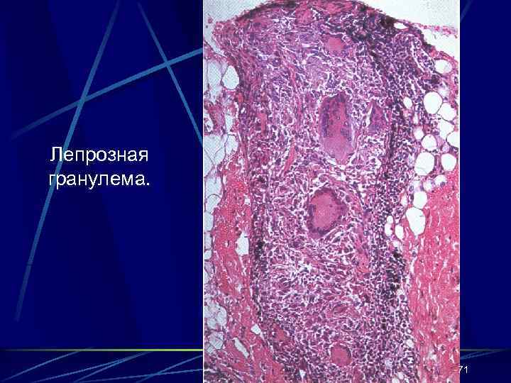 Лепрозная гранулема. 71 