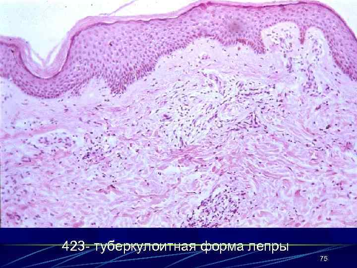 423 - туберкулоитная форма лепры 75 