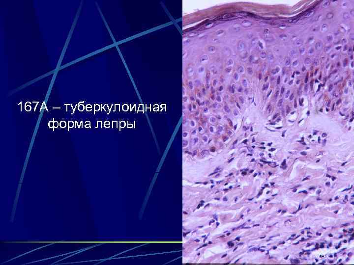 167 А – туберкулоидная форма лепры 76 
