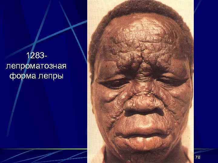 1283 лепроматозная форма лепры 78 