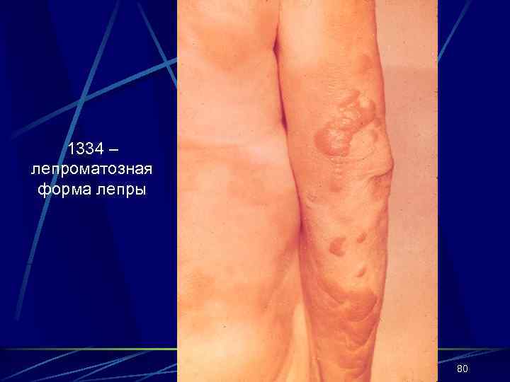1334 – лепроматозная форма лепры 80 