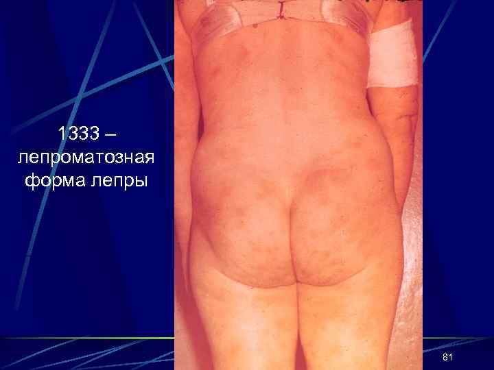 1333 – лепроматозная форма лепры 81 