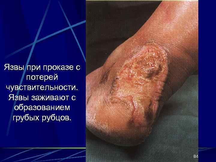 Язвы при проказе с потерей чувствительности. Язвы заживают с образованием грубых рубцов. 84 