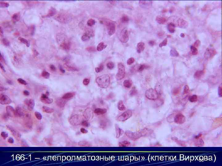 166 -1 – «лепролматозные шары» (клетки Вирхова) 88 