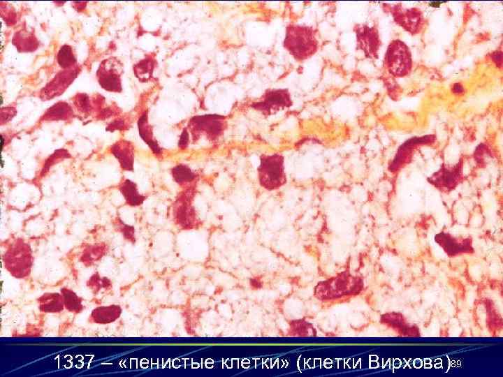 1337 – «пенистые клетки» (клетки Вирхова)89 