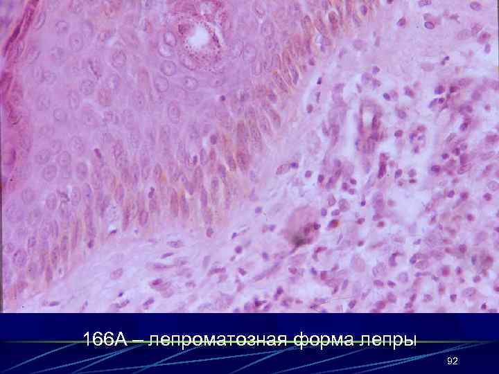 166 А – лепроматозная форма лепры 92 