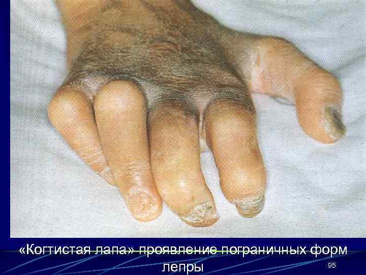  «Когтистая лапа» проявление пограничных форм 95 лепры 