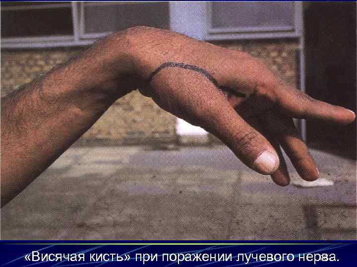 96 «Висячая кисть» при поражении лучевого нерва. 