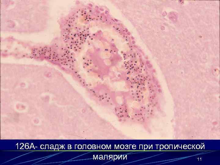 126 А- сладж в головном мозге при тропической малярии 11 