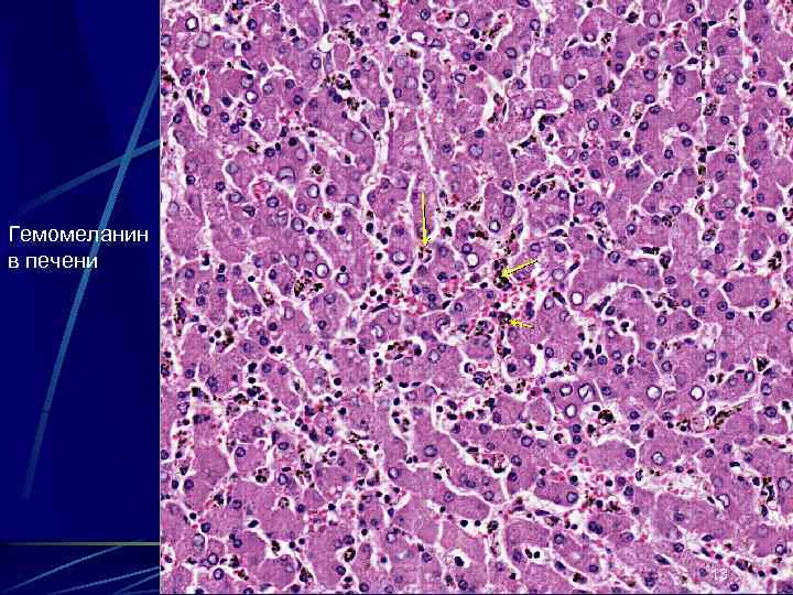 Гемомеланин в печени 13 