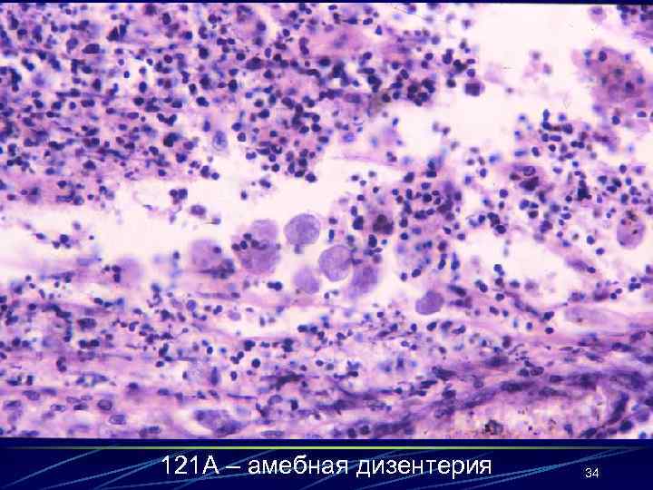121 А – амебная дизентерия 34 