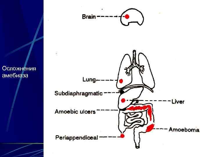 Осложнения амебиаза 39 