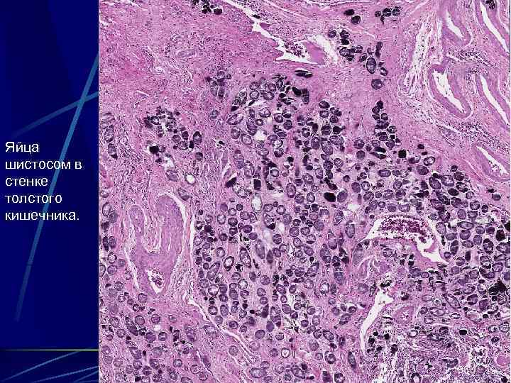Яйца шистосом в стенке толстого кишечника. 85 