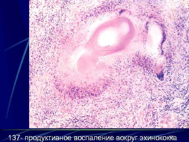 93 137 - продуктивное воспаление вокруг эхинококка 