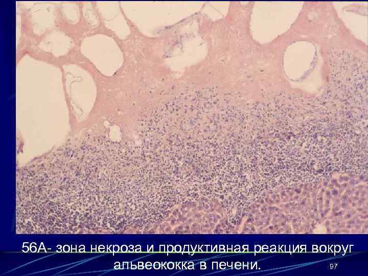 56 А- зона некроза и продуктивная реакция вокруг 97 альвеококка в печени. 