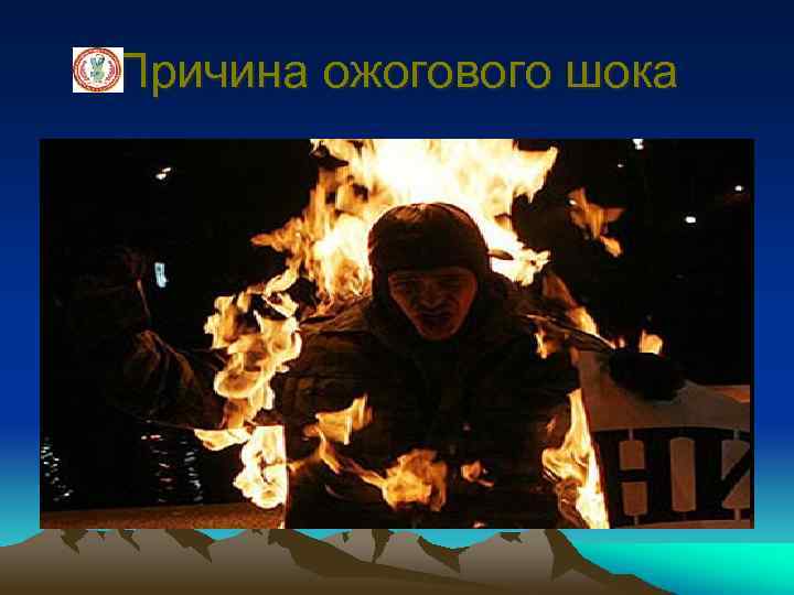 Причина ожогового шока 