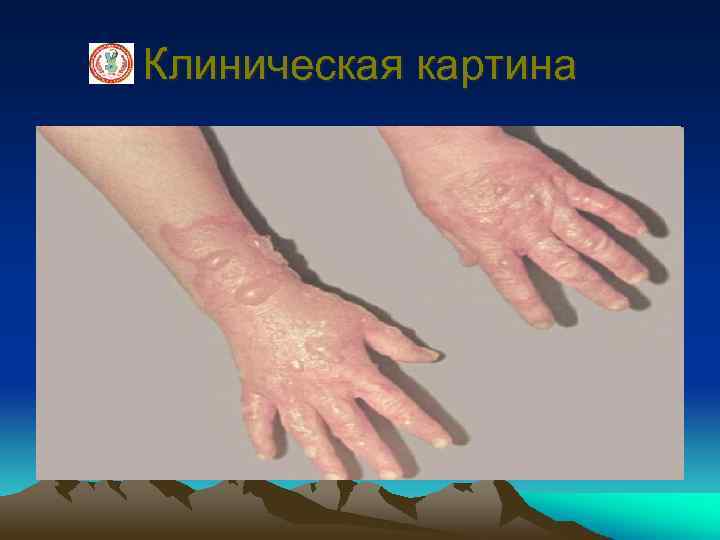 Клиническая картина 